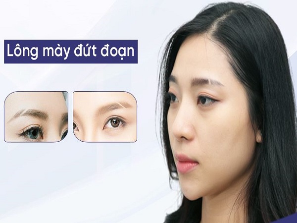 Lông mày mọc lộn xộn, đứt quãng
